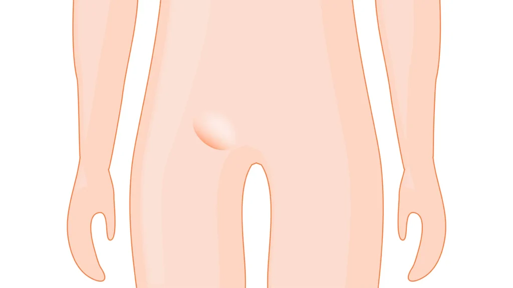 鼠径部のふくらみ