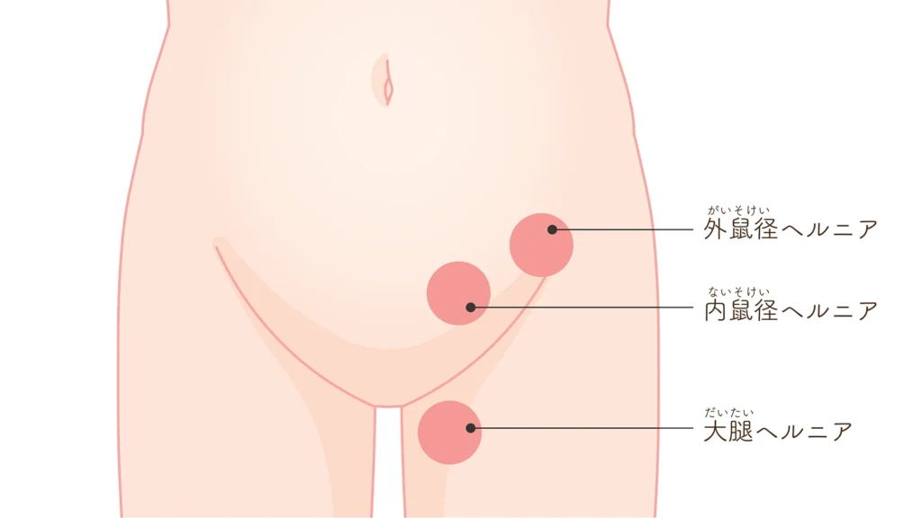 鼠径ヘルニアの分類