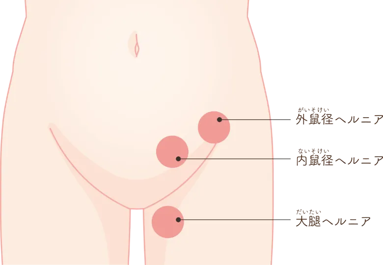 「外鼠径ヘルニア」「内鼠径ヘルニア」「大腿ヘルニア」